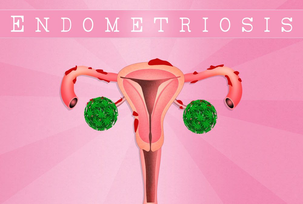 Why Weed is the Best Thing That’s Happened to Endometrosis Patients in the Last 50 Years